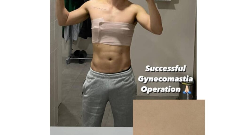 A Young Male happy after successful gyno surgery.

