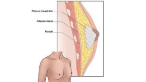 Increasing gynecomastia tissues in chest. 