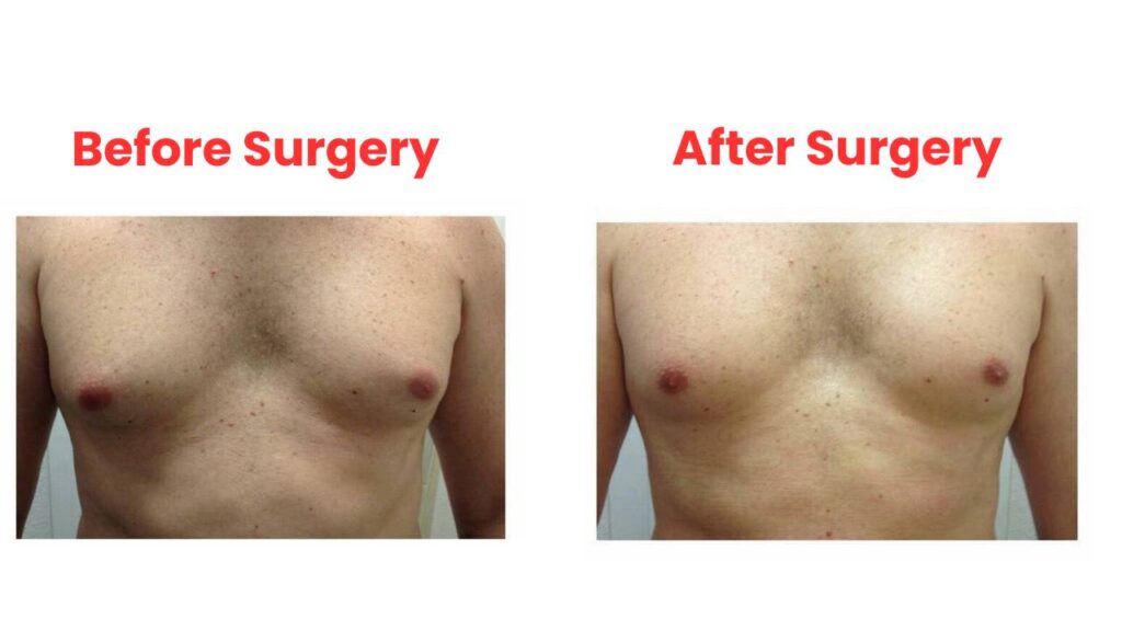 This is a photo of a patient from Delhi before and after gynecomastia surgery. 